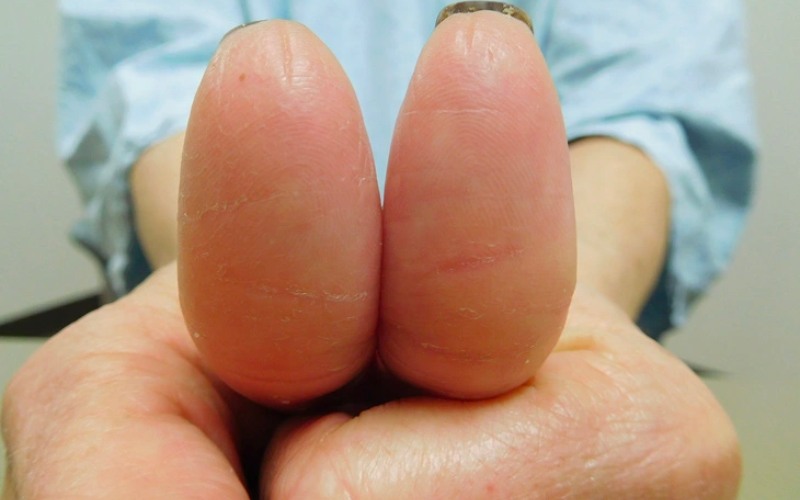Hình ảnh ngón tay bị mất dấu vân tay của người phụ nữ đang điều trị ung thư vú